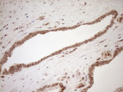 CWC27 Antibody - Immunohistochemical staining of paraffin-embedded Carcinoma of Human prostate tissue using anti-CWC27 mouse monoclonal antibody. (Heat-induced epitope retrieval by 1mM EDTA in 10mM Tris buffer. (pH8.5) at 120°C for 3 min. (1:150)