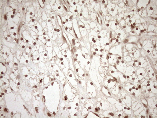 CWC27 Antibody - Immunohistochemical staining of paraffin-embedded Carcinoma of Human kidney tissue using anti-CWC27 mouse monoclonal antibody. (Heat-induced epitope retrieval by 1mM EDTA in 10mM Tris buffer. (pH8.5) at 120°C for 3 min. (1:150)