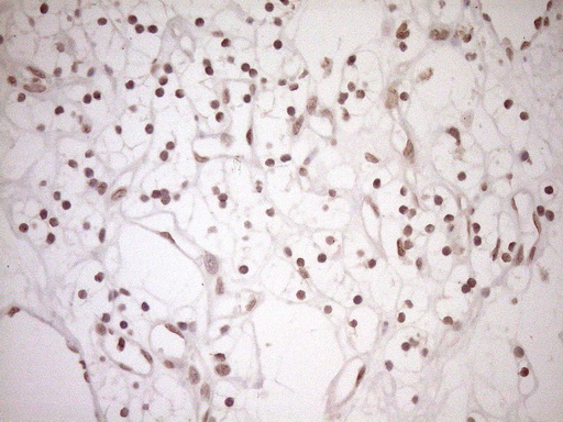 CWC27 Antibody - Immunohistochemical staining of paraffin-embedded Carcinoma of Human kidney tissue using anti-CWC27 mouse monoclonal antibody. (Heat-induced epitope retrieval by 1mM EDTA in 10mM Tris buffer. (pH8.5) at 120°C for 3 min. (1:150)