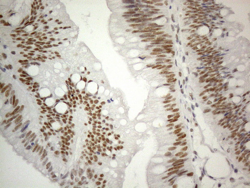 CWC27 Antibody - Immunohistochemical staining of paraffin-embedded Carcinoma of Human pancreas tissue using anti-CWC27 mouse monoclonal antibody. (Heat-induced epitope retrieval by 1mM EDTA in 10mM Tris buffer. (pH8.5) at 120°C for 3 min. (1:150)