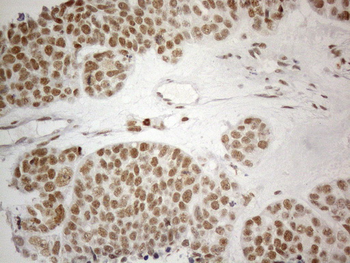 CWC27 Antibody - Immunohistochemical staining of paraffin-embedded Adenocarcinoma of Human endometrium tissue using anti-CWC27 mouse monoclonal antibody. (Heat-induced epitope retrieval by 1mM EDTA in 10mM Tris buffer. (pH8.5) at 120°C for 3 min. (1:150)