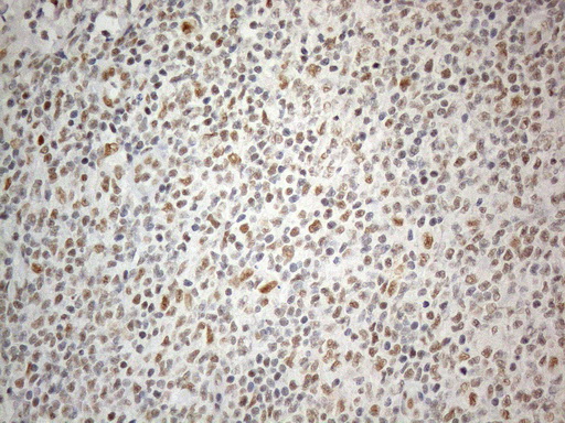 CWC27 Antibody - Immunohistochemical staining of paraffin-embedded Human lymphoma tissue using anti-CWC27 mouse monoclonal antibody. (Heat-induced epitope retrieval by 1mM EDTA in 10mM Tris buffer. (pH8.5) at 120°C for 3 min. (1:150)