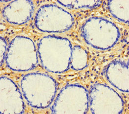 CX3CL1 / Fractalkine Antibody - Immunohistochemistry of paraffin-embedded human gastric cancer using CX3CL1 Antibody at dilution of 1:100