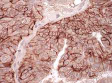 CXADR Antibody - Detection of Human CAR by Immunohistochemistry. Sample: FFPE section of human ovarian carcinoma. Antibody: Affinity purified rabbit anti-CAR used at a dilution of 1:1000 (1 ug/ml). Detection: Vector Laboratories ImmPACT NovaRED Peroxidase Substrate.
