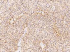 CXADR Antibody - Immunochemical staining of human CXADR in human bladder carcinoma with rabbit polyclonal antibody at 1:500 dilution, formalin-fixed paraffin embedded sections.