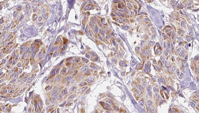 CXCL10 / IP-10 Antibody - 1:100 staining human Melanoma tissue by IHC-P. The sample was formaldehyde fixed and a heat mediated antigen retrieval step in citrate buffer was performed. The sample was then blocked and incubated with the antibody for 1.5 hours at 22°C. An HRP conjugated goat anti-rabbit antibody was used as the secondary.