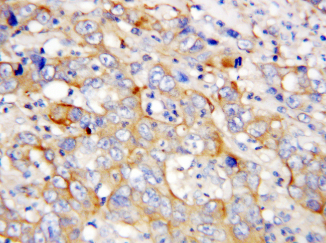 CXCL4 / PF4 Antibody - CXCL4 / PF4 antibody. IHC(P): Human Lung Cancer Tissue.