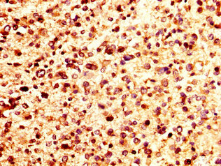 CXCL4 / PF4 Antibody - Immunohistochemistry image at a dilution of 1:200 and staining in paraffin-embedded human glioma cancer performed on a Leica BondTM system. After dewaxing and hydration, antigen retrieval was mediated by high pressure in a citrate buffer (pH 6.0) . Section was blocked with 10% normal goat serum 30min at RT. Then primary antibody (1% BSA) was incubated at 4 °C overnight. The primary is detected by a biotinylated secondary antibody and visualized using an HRP conjugated SP system.