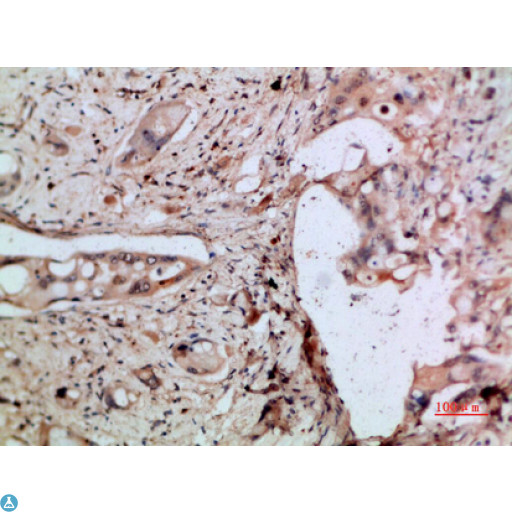 CXCL5 Antibody - Immunohistochemical analysis of paraffin-embedded human-pancreas-cancer, antibody was diluted at 1:200.