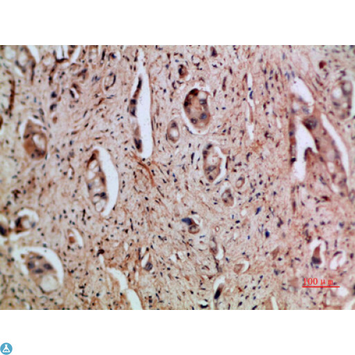 CXCL5 Antibody - Immunohistochemical analysis of paraffin-embedded human-pancreas-cancer, antibody was diluted at 1:200.