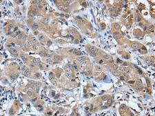 CXCL5 Antibody - Immunohistochemistry of paraffin-embedded Human breast cancer tissue  using CXCL5 Polyclonal Antibody at dilution of 1:45(×200)
