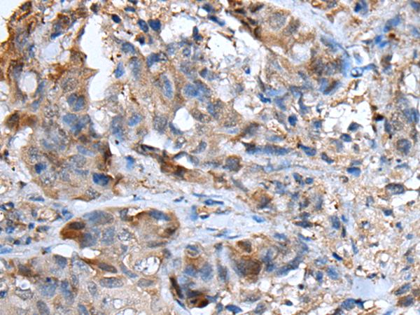 CXCL5 Antibody - Immunohistochemistry of paraffin-embedded Human breast cancer tissue  using CXCL5 Polyclonal Antibody at dilution of 1:50(×200)