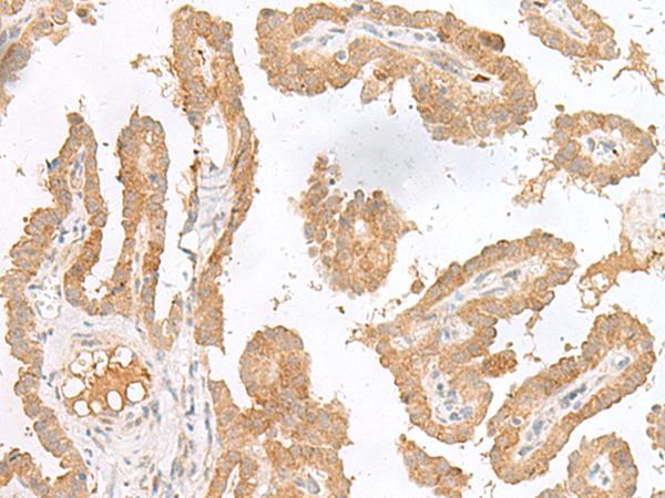 CXCL6 Antibody - Immunohistochemistry of paraffin-embedded Human thyroid cancer tissue  using CXCL6 Polyclonal Antibody at dilution of 1:45(×200)