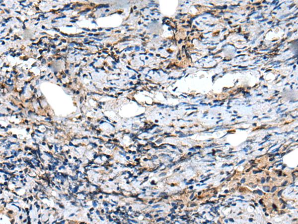 CXCL6 Antibody - Immunohistochemistry of paraffin-embedded Human prost ate cancer tissue  using CXCL6 Polyclonal Antibody at dilution of 1:60(×200)