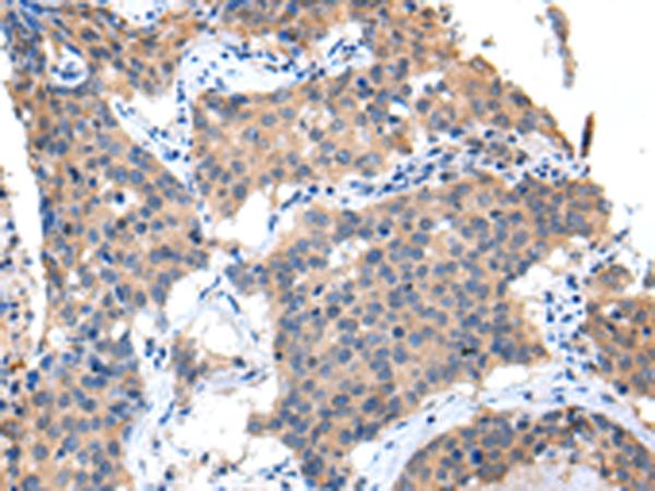 CXCL7 / PPBP Antibody - Immunohistochemistry of paraffin-embedded Human lung cancer tissue  using PPBP Polyclonal Antibody at dilution of 1:35(×200)