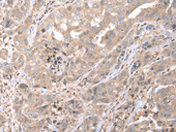 CXCL7 / PPBP Antibody - Immunohistochemistry of paraffin-embedded Human breast cancer tissue  using PPBP Polyclonal Antibody at dilution of 1:35(×200)