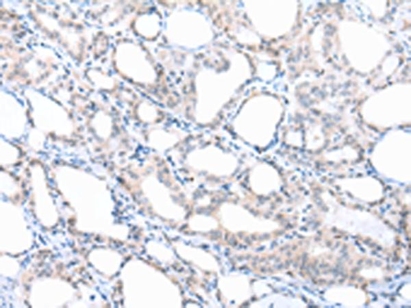 CXCL7 / PPBP Antibody - Immunohistochemistry of paraffin-embedded Human thyroid cancer tissue  using PPBP Polyclonal Antibody at dilution of 1:30(×200)