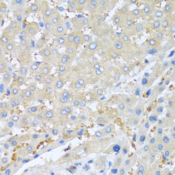 CXCL7 / PPBP Antibody - Immunohistochemistry of paraffin-embedded Human liver cancer using PPBP Polyclonal Antibody at dilution of 1:100 (40x lens).