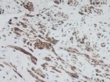CXCL9 / MIG Antibody - Immunohistochemistry of formalin-fixed, paraffin-embedded human renal tumor with parenchymal tissue stained with Rabbit anti-Human CXCL9 following heat mediated antigen retrieval using sodium citrate buffer (pH6.0)