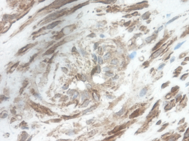 CXCL9 / MIG Antibody - Immunohistochemistry of formalin-fixed, paraffin-embedded human renal tumor with parenchymal tissue stained with Rabbit anti-Human CXCL9 following heat mediated antigen retrieval using sodium citrate buffer (pH6.0)