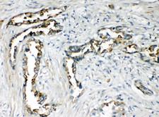 CXCR1 Antibody - CXCR1 antibody. IHC(P): Human Lung Cancer Tissue.