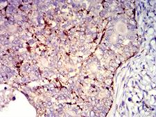 CXCR2 Antibody - Immunohistochemical analysis of paraffin-embedded cervical cancer tissues using CD182 mouse mAb with DAB staining.