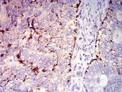 CXCR2 Antibody - Immunohistochemical analysis of paraffin-embedded cervical cancer tissues using CD182 mouse mAb with DAB staining.