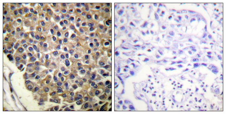 CXCR2 Antibody - Immunohistochemistry analysis of paraffin-embedded human breast carcinoma, using IL-8R beta/CDw128 beta (Phospho-Ser347) Antibody. The picture on the right is blocked with the phospho peptide.