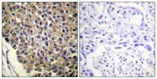CXCR2 Antibody - Immunohistochemistry analysis of paraffin-embedded human breast carcinoma, using IL-8R beta/CDw128 beta (Phospho-Ser347) Antibody. The picture on the right is blocked with the phospho peptide.