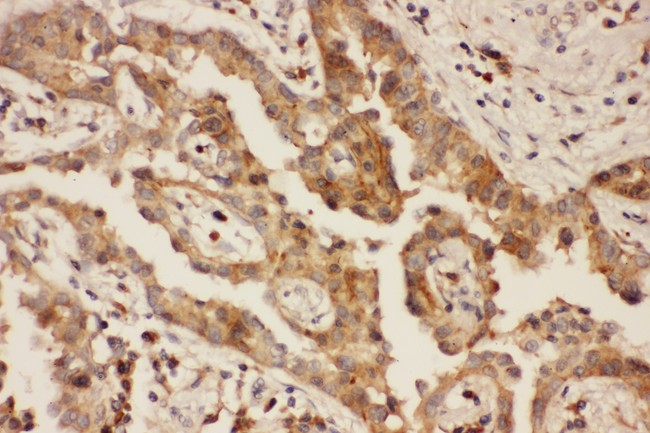 CXCR3 Antibody - CXCR3 antibody IHC-paraffin: Human Lung Cancer Tissue.