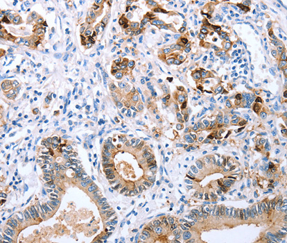 CXCR3 Antibody - Immunohistochemistry of paraffin-embedded human stomach cancer tissue using CXCR3 antibody.