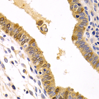CXCR3 Antibody - Immunohistochemistry of paraffin-embedded human metrocarcinoma tissue.