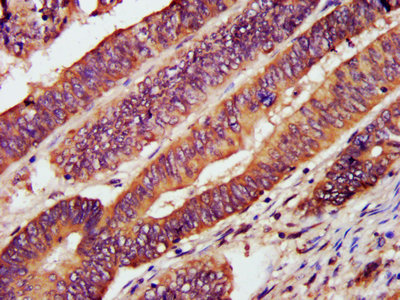 CXCR3 Antibody - Immunohistochemistry Dilution at 1:1200 and staining in paraffin-embedded human colon cancer performed on a Leica BondTM system. After dewaxing and hydration, antigen retrieval was mediated by high pressure in a citrate buffer (pH 6.0). Section was blocked with 10% normal Goat serum 30min at RT. Then primary antibody (1% BSA) was incubated at 4°C overnight. The primary is detected by a biotinylated Secondary antibody and visualized using an HRP conjugated SP system.