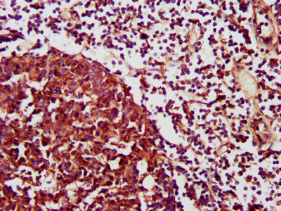 CXCR3 Antibody - Immunohistochemistry Dilution at 1:1200 and staining in paraffin-embedded human lymph node tissue performed on a Leica BondTM system. After dewaxing and hydration, antigen retrieval was mediated by high pressure in a citrate buffer (pH 6.0). Section was blocked with 10% normal Goat serum 30min at RT. Then primary antibody (1% BSA) was incubated at 4°C overnight. The primary is detected by a biotinylated Secondary antibody and visualized using an HRP conjugated SP system.