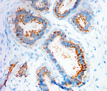 CXCR4 Antibody - IHC-P: CXCR4 antibody testing of human mammary cancer tissue
