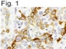 CXCR4 Antibody - Immunohistochemistry: CXCR4 Antibody - Figure 1 illustrates immunostaining of CXCR4 in human cervical carcinoma tissue sections.
