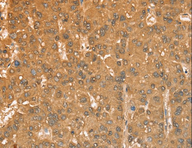 CXCR4 Antibody - Immunohistochemistry of paraffin-embedded Human gastric cancer using CXCR4 Polyclonal Antibody at dilution of 1:50.