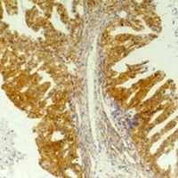CXCR4 Antibody - Immunohistochemical analysis of CD184 staining in human breast cancer;human tonsil formalin fixed paraffin embedded tissue section. The section was pre-treated using heat mediated antigen retrieval with sodium citrate buffer (pH 6.0). The section was then incubated with the antibody at room temperature and detected using an HRP conjugated compact polymer system. DAB was used as the chromogen. The section was then counterstained with hematoxylin and mounted with DPX.