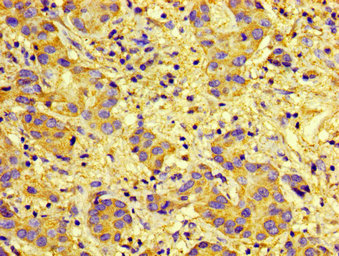 CXCR5 Antibody - Immunohistochemistry image of paraffin-embedded human liver cancer at a dilution of 1:100