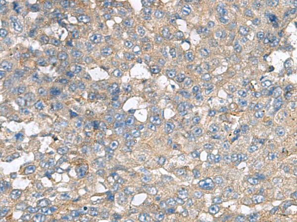 CXCR5 Antibody - Immunohistochemistry of paraffin-embedded Human liver cancer tissue  using CXCR5 Polyclonal Antibody at dilution of 1:80(×200)