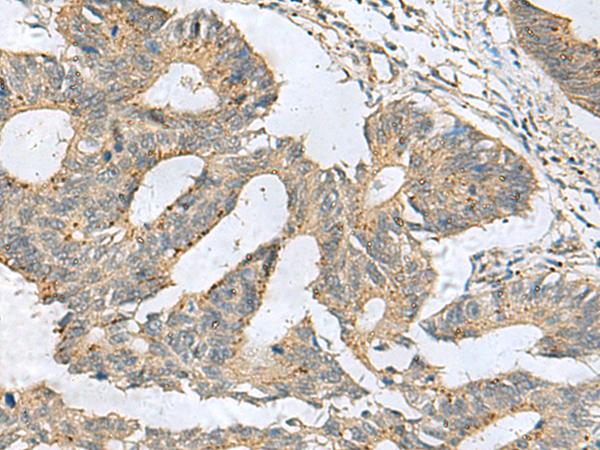 CXCR5 Antibody - Immunohistochemistry of paraffin-embedded Human colorectal cancer tissue  using CXCR5 Polyclonal Antibody at dilution of 1:80(×200)