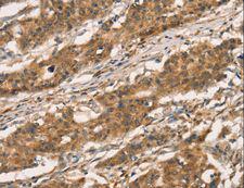 CXCR6 Antibody - Immunohistochemistry of paraffin-embedded Human gastric cancer using CXCR6 Polyclonal Antibody at dilution of 1:30.