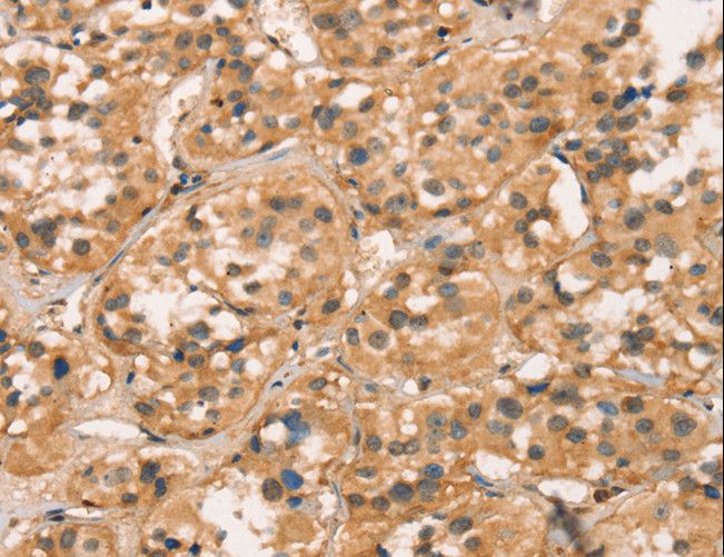 CXCR6 Antibody - Immunohistochemistry of paraffin-embedded Human thyroid cancer using CXCR6 Polyclonal Antibody at dilution of 1:30.