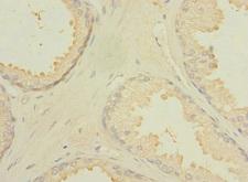 CXorf21 Antibody - Immunohistochemistry of paraffin-embedded human prostate cancer using CXorf21 Antibody at dilution of 1:100