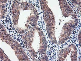 CXorf26 Antibody - IHC of paraffin-embedded Adenocarcinoma of Human endometrium tissue using anti-CXorf26 mouse monoclonal antibody.
