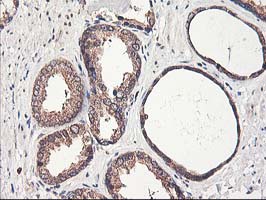 CXorf26 Antibody - IHC of paraffin-embedded Carcinoma of Human prostate tissue using anti-CXorf26 mouse monoclonal antibody.