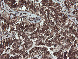 CXorf26 Antibody - IHC of paraffin-embedded Adenocarcinoma of Human ovary tissue using anti-CXorf26 mouse monoclonal antibody. (Heat-induced epitope retrieval by 10mM citric buffer, pH6.0, 100C for 10min).