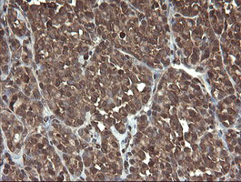 CXorf26 Antibody - IHC of paraffin-embedded Carcinoma of Human thyroid tissue using anti-CXorf26 mouse monoclonal antibody. (Heat-induced epitope retrieval by 10mM citric buffer, pH6.0, 100C for 10min).