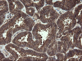 CXorf26 Antibody - IHC of paraffin-embedded Adenocarcinoma of Human endometrium tissue using anti-CXorf26 mouse monoclonal antibody. (Heat-induced epitope retrieval by 10mM citric buffer, pH6.0, 100C for 10min).