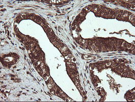 CXorf26 Antibody - IHC of paraffin-embedded Carcinoma of Human prostate tissue using anti-CXorf26 mouse monoclonal antibody. (Heat-induced epitope retrieval by 10mM citric buffer, pH6.0, 100C for 10min).